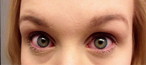 Roodheid van het oog is een van de symptomen van een allergie